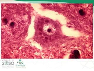 Rabies (2) | PPTX