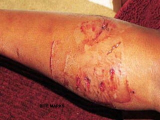 BITE MARKS
 