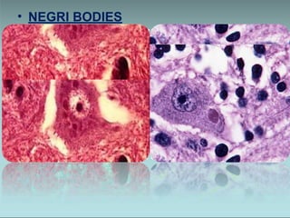 Rabies Inclusions Comprehensive Overview of Rabies: Virus, Transmission, Symptoms, and ...