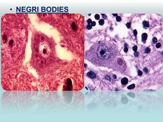 • NEGRI BODIES
• EOSINOPHILIC CYTOPLASMIC INCLUSIONS in brain
  neurons

• Randomly oriented rabies virus nucleocapsids
  embedded in the matrix

• Seen mainly in purkinje cells of cerebellum
                 pyramidal cells of hippocampus

• Absence of negri bodies-not an exclusion to rabies
 
