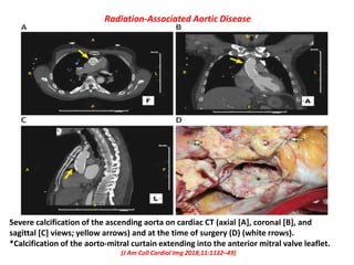 Radiation Associated Cardiac Disease | PPTX