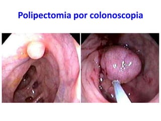 Polipectomia por colonoscopia

 