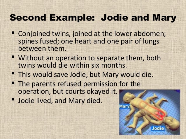 Conjoined twins murder case image