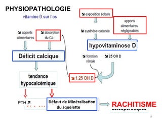14
PTH  Défaut de Minéralisation
du squelette RACHITISME
PHYSIOPATHOLOGIE
 