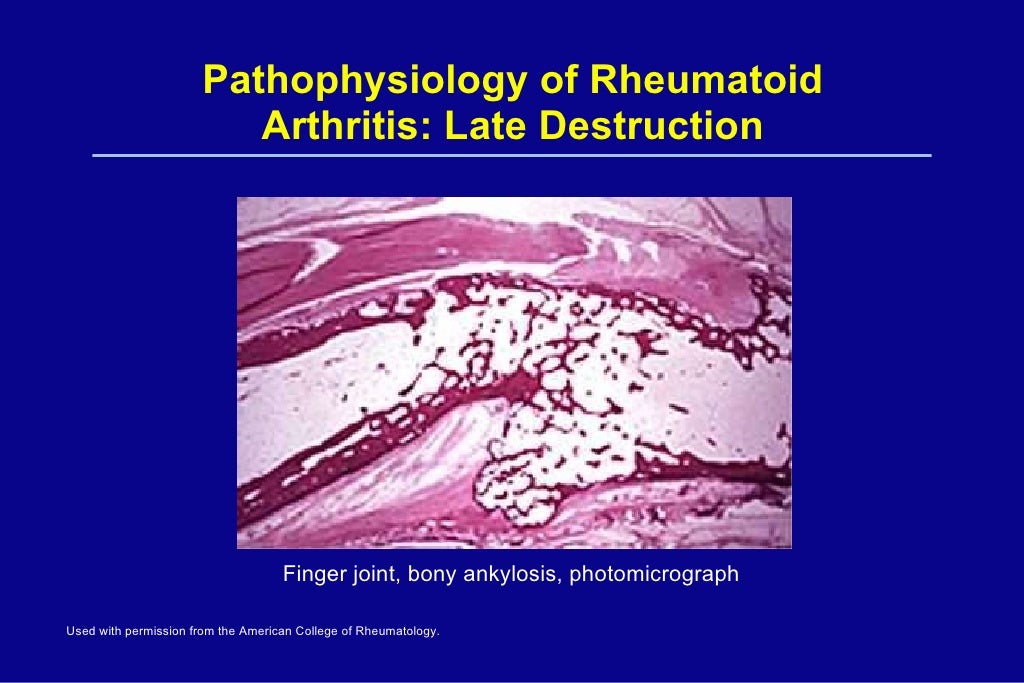 rheumatoid arthritis