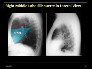 Right Middle Lobe Silhouette in Lateral View<br />4/15/2010<br />12<br />
