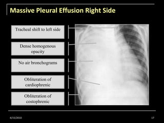 Massive Pleural Effusion Right Side<br />4/15/2010<br />17<br />Tracheal shift to left side<br />Dense homogenous opacity<...