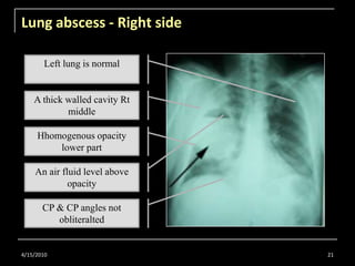 Lung abscess - Right side<br />4/15/2010<br />21<br />Left lung is normal<br />A thick walled cavity Rt middle<br />Hhomog...