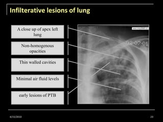 Infilterative lesions of lung<br />4/15/2010<br />23<br />A close up of apex left lung<br />Non-homogenous opacities <br /...