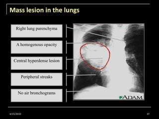 Mass lesion in the lungs<br />4/15/2010<br />37<br />Right lung parenchyma<br />A homogenous opacity<br />Central hyperden...