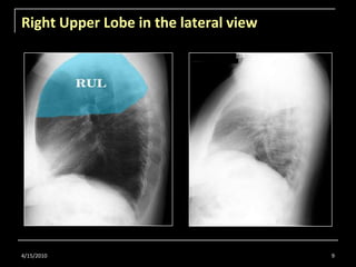 Right Upper Lobe in the lateral view<br />4/15/2010<br />9<br />