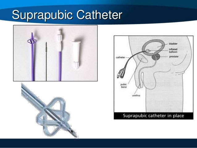 types of catheters
