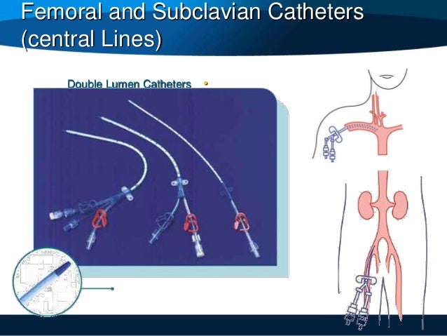 care of patient with subclavian triple lumen central line care of patient with subclavian triple lumen central line