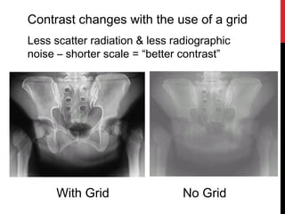 Rad 206 p12 Fundamentals of Imaging - Control of Scatter Radiation | PPT