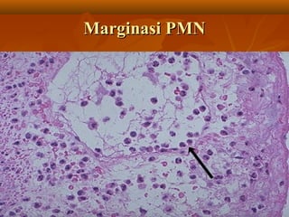 Marginasi PMN
 
