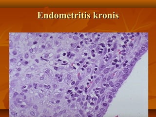 Endometritis kronis
 