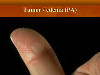 Tumor / edema (PA)
 