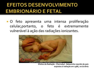  O feto apresenta uma intensa proliferação
celular,portanto, o feto é extremamente
vulnerável à ação das radiações ionizantes.
Efeitos da Radiação - Chernobyl - Bebezinho nascido de pais
expostos à radiação em 1986, na Ucrânia
 