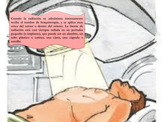 Cuando la radiación se administra internamente
recibe el nombre de braquiterapia, y se aplica muy
cerca del tumor o dentro del mismo. La fuente de
radiación está casi siempre sellada en un portador
pequeño (o implante), que puede ser un alambre, un
tubo plástico o catéter, una cinta, una cápsula o
semilla.
 