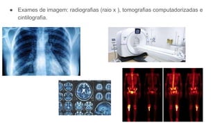 ● Exames de imagem: radiografias (raio x ), tomografias computadorizadas e
cintilografia.
 