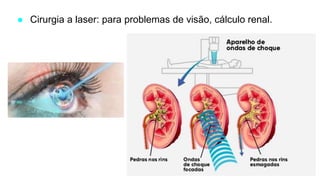 ● Cirurgia a laser: para problemas de visão, cálculo renal.
 