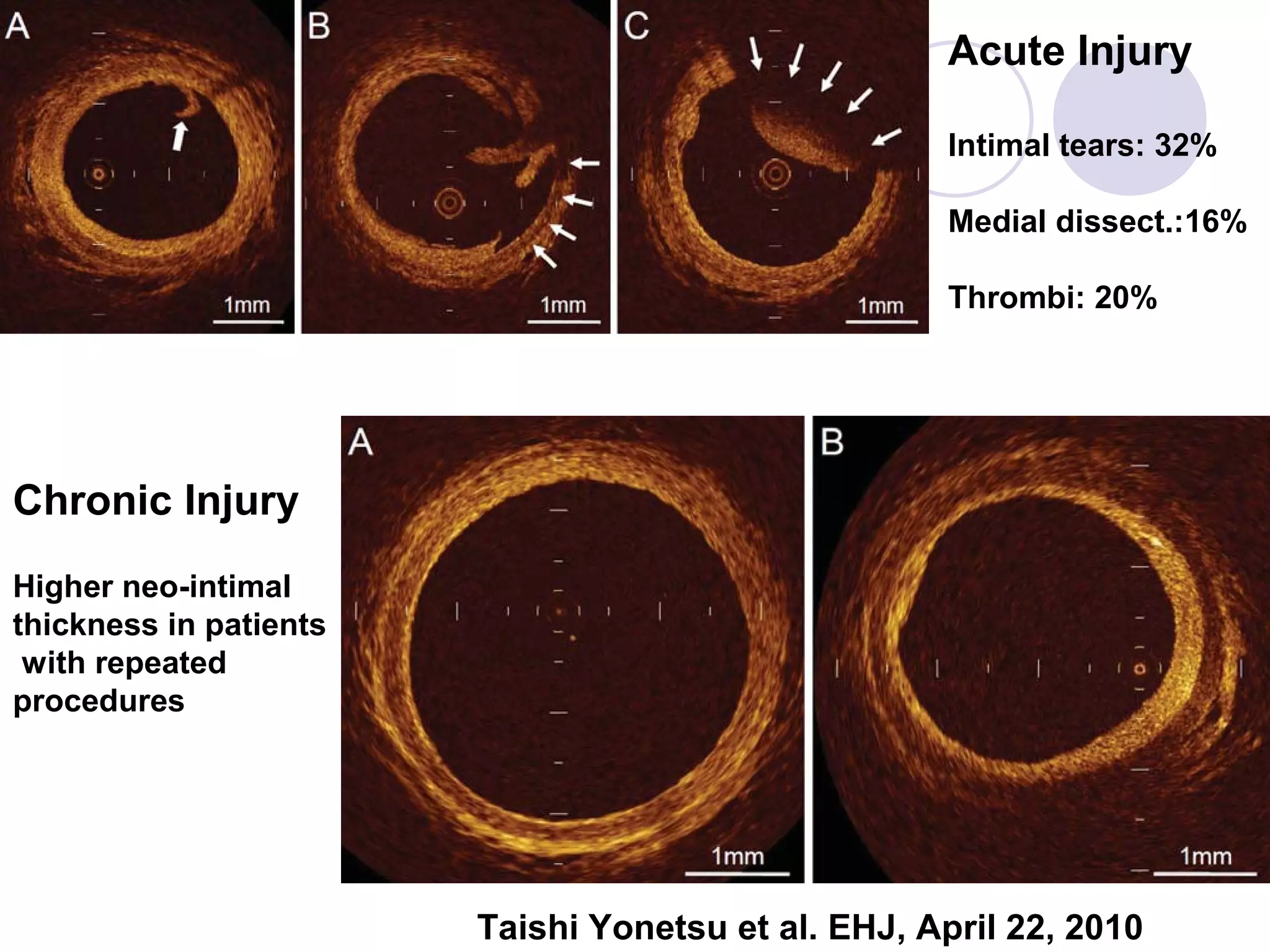 Acute Injury
Intimal tears: 32%
Medial dissect.:16%
Thrombi: 20%

Chronic Injury
Higher neo-intimal
thickness in patients
with repeated
procedures

Taishi Yonetsu et al. EHJ, April 22, 2010

 