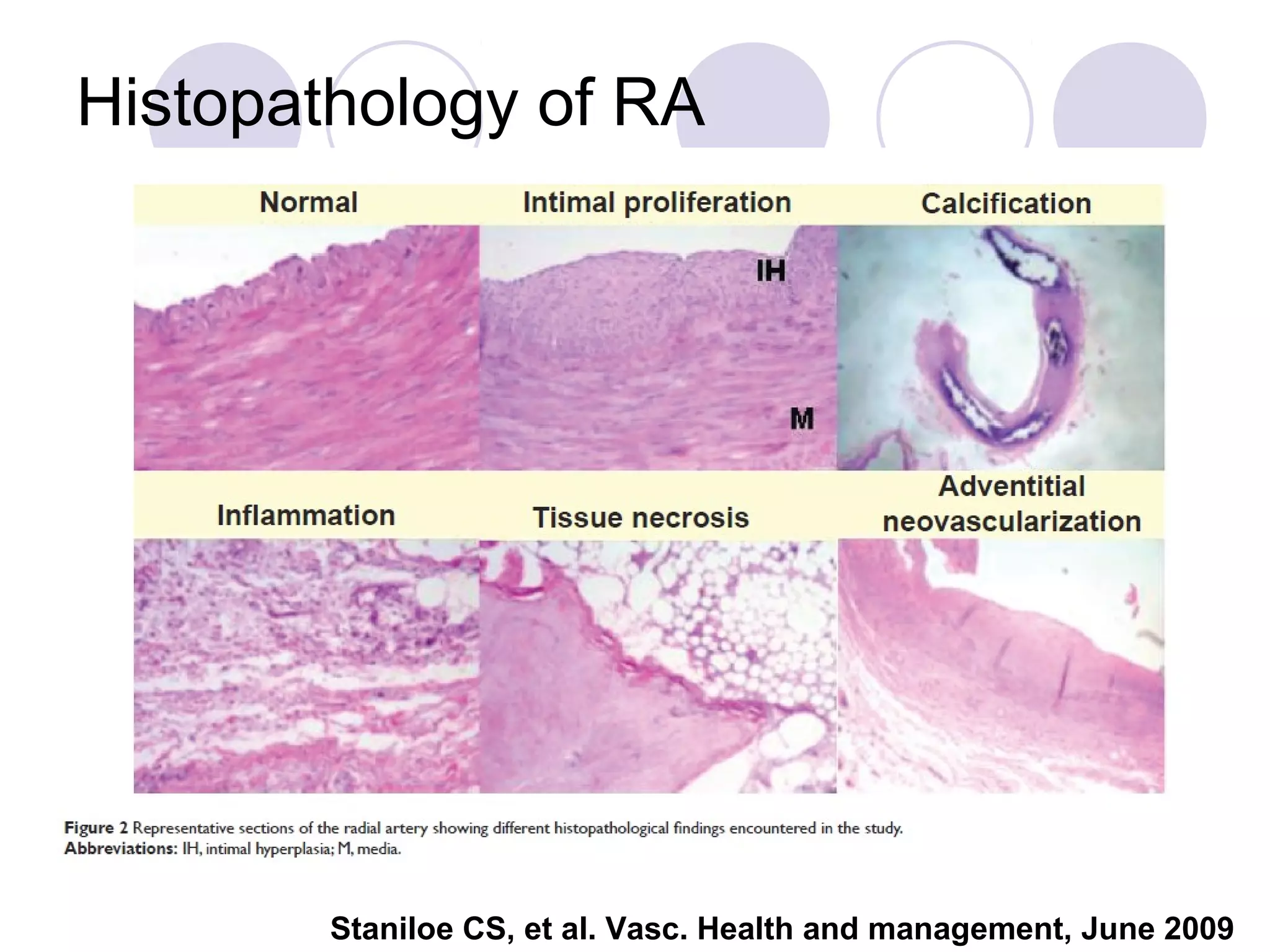 Histopathology of RA

Staniloe CS, et al. Vasc. Health and management, June 2009

 