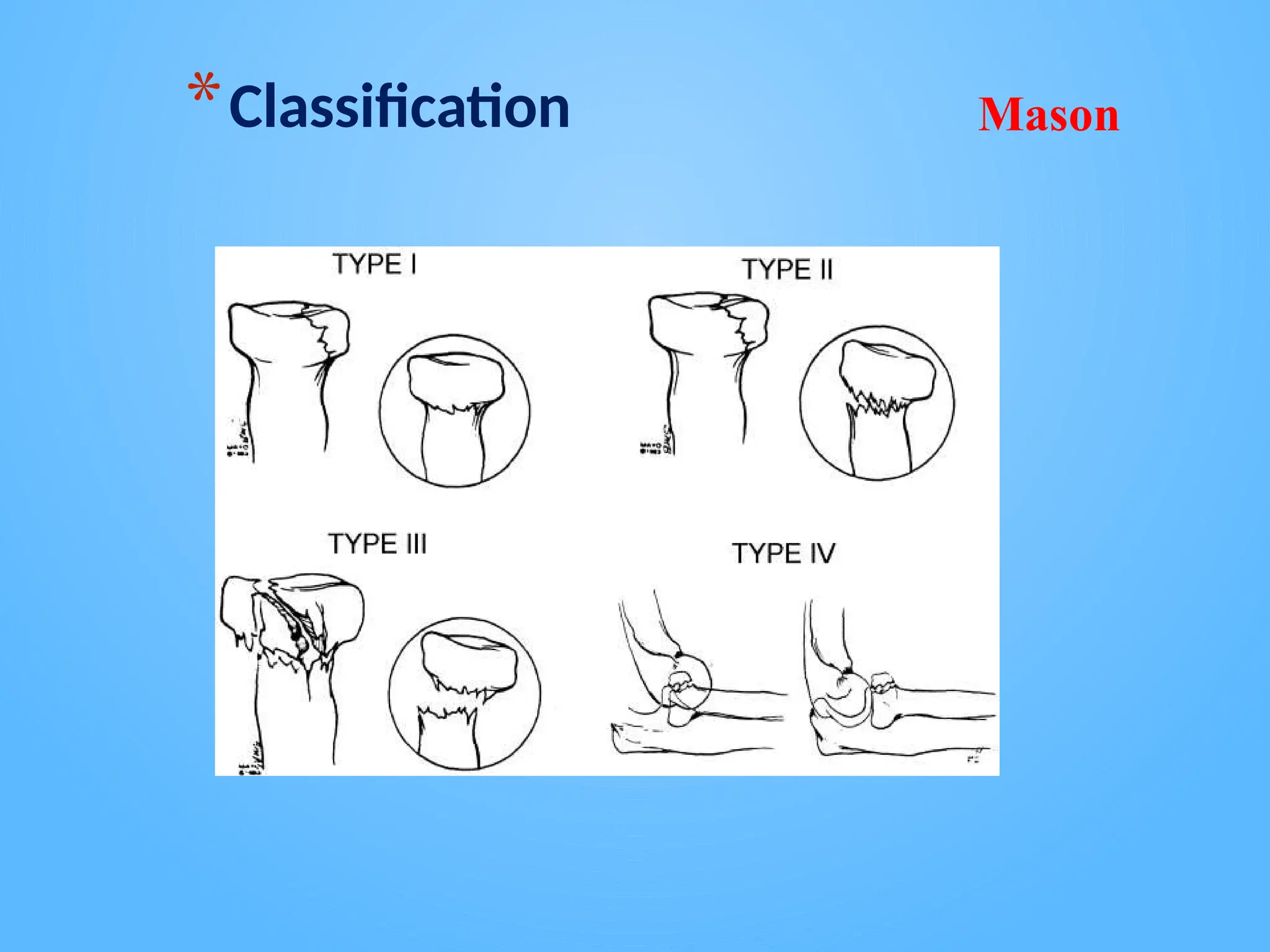 radial-head-fractures-treatment-lecture.pptx