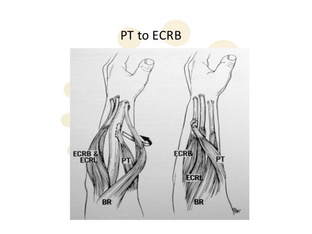 Radial Nerve palsy tendon transfers