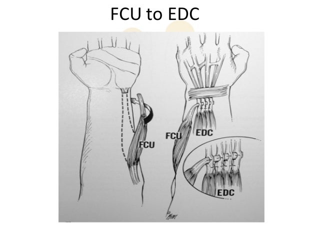 Radial Nerve palsy tendon transfers