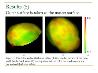 Results (5) Figure 4: The color-coded thickness values plotted on the surface of the outer skull: (a) the back view; (b)   the top view; (c) the color bar used to code the normalized thickness values. Outer surface is taken as the master surface  