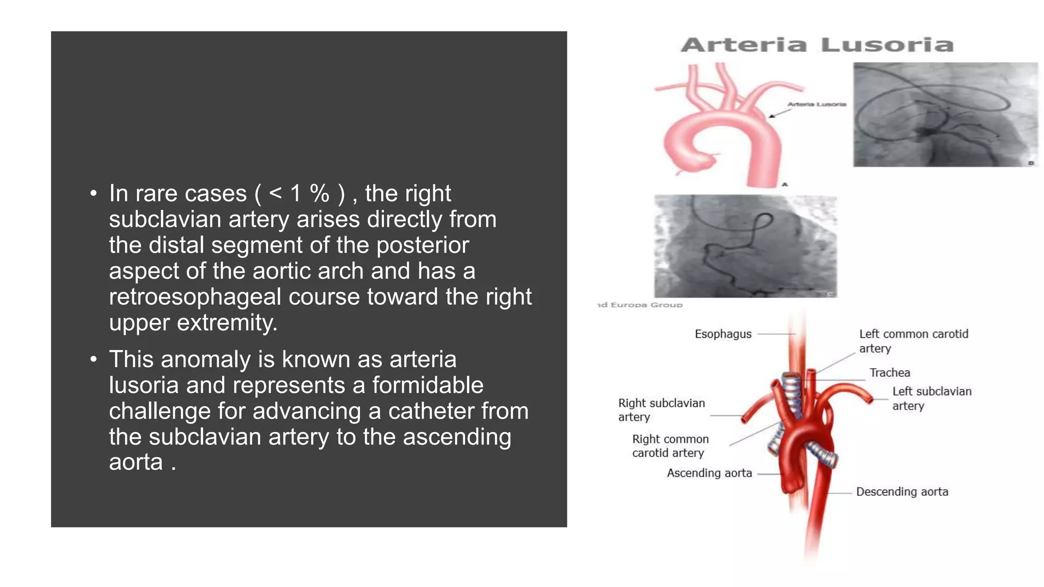 • In rare cases ( < 1 % ) , the right
subclavian artery arises directly from
the distal segment of the posterior
aspect of the aortic arch and has a
retroesophageal course toward the right
upper extremity.
• This anomaly is known as arteria
lusoria and represents a formidable
challenge for advancing a catheter from
the subclavian artery to the ascending
aorta .
 
