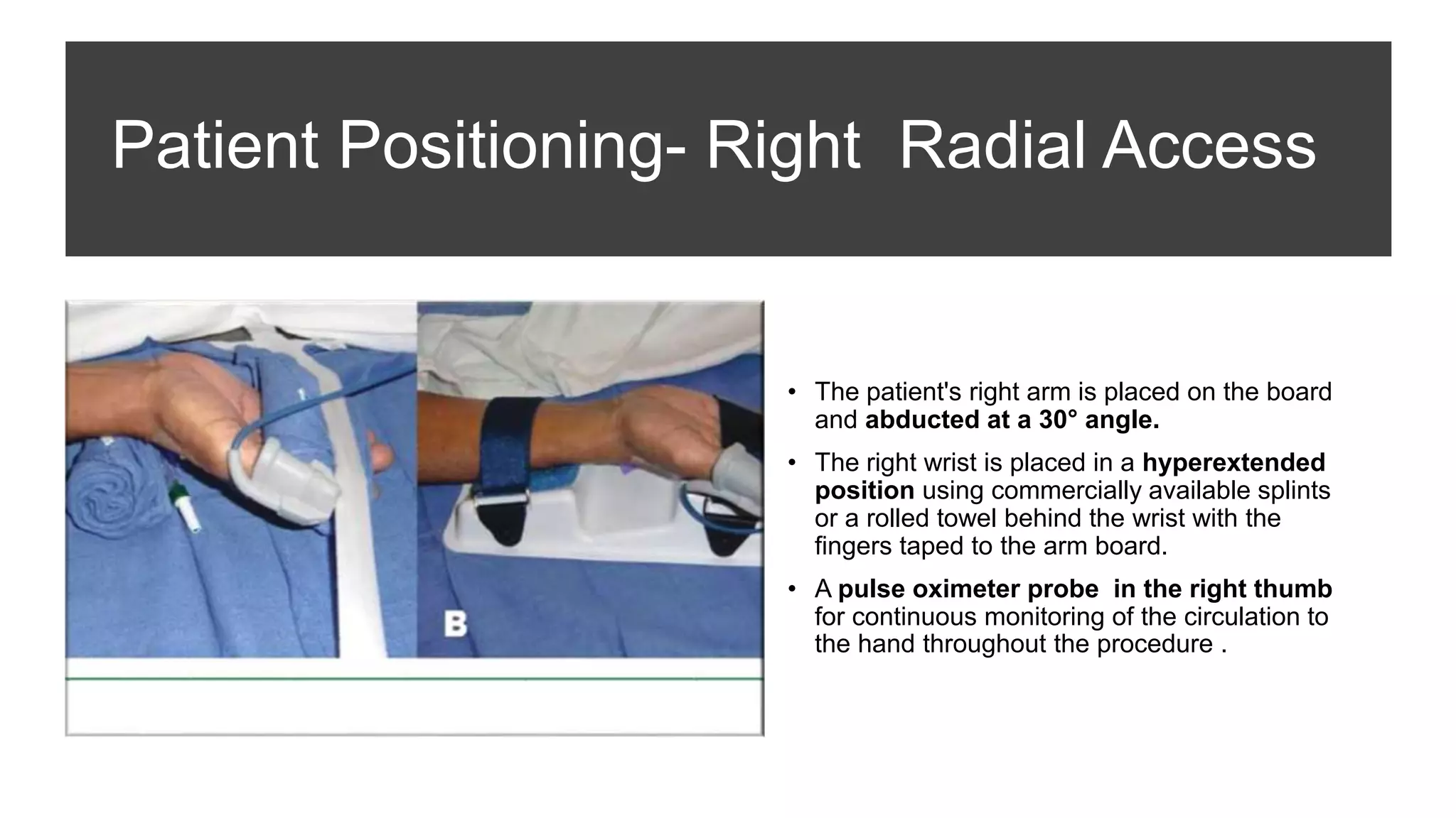 Patient Positioning- Right Radial Access
• The patient's right arm is placed on the board
and abducted at a 30° angle.
• The right wrist is placed in a hyperextended
position using commercially available splints
or a rolled towel behind the wrist with the
fingers taped to the arm board.
• A pulse oximeter probe in the right thumb
for continuous monitoring of the circulation to
the hand throughout the procedure .
 