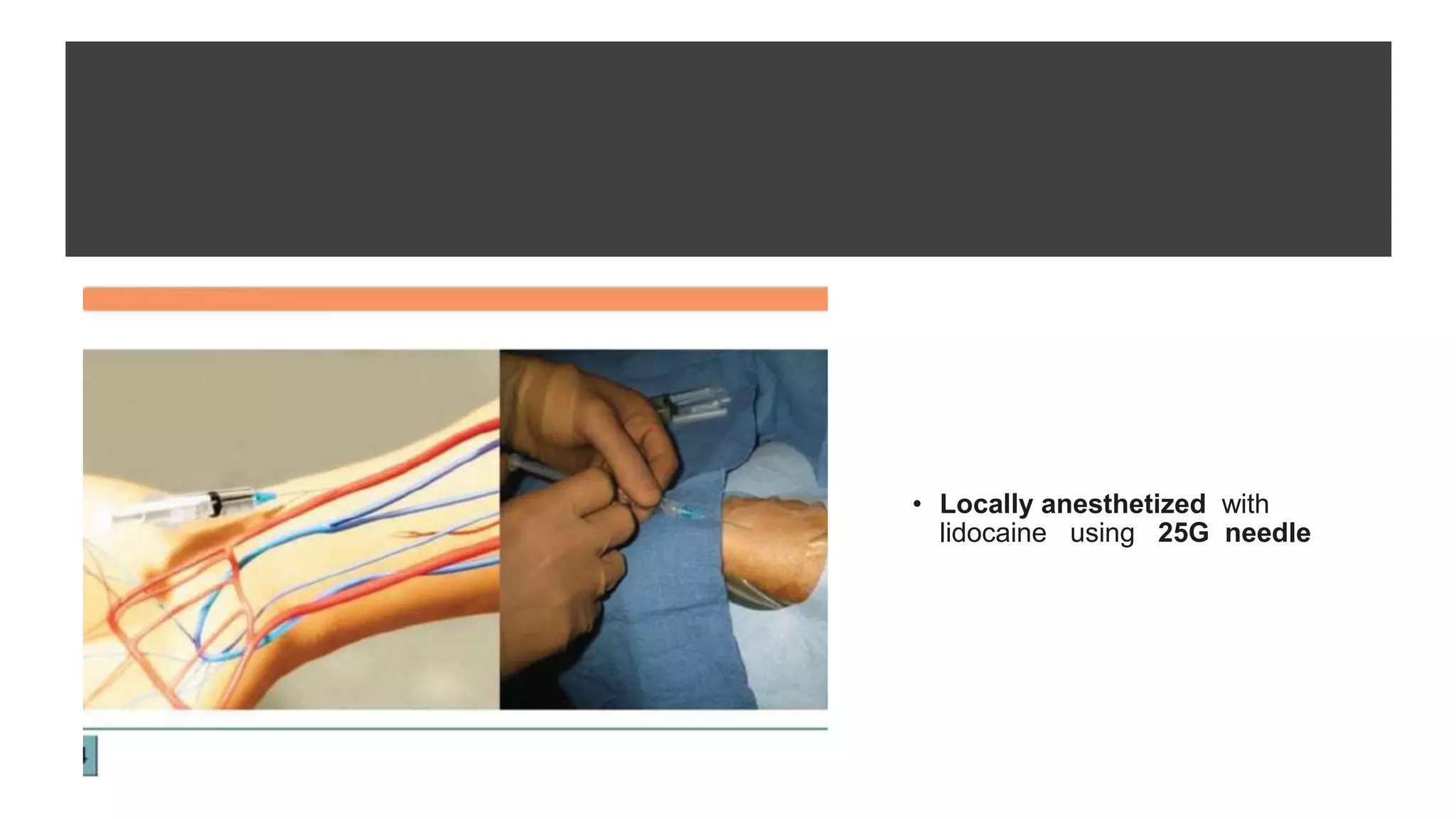 • Locally anesthetized with
lidocaine using 25G needle
 