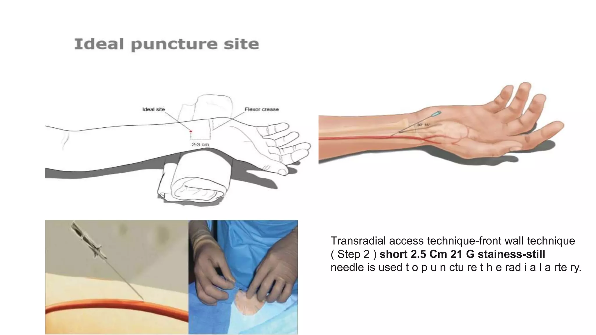 Transradial access technique-front wall technique
( Step 2 ) short 2.5 Cm 21 G stainess-still
needle is used t o p u n ctu re t h e rad i a l a rte ry.
 