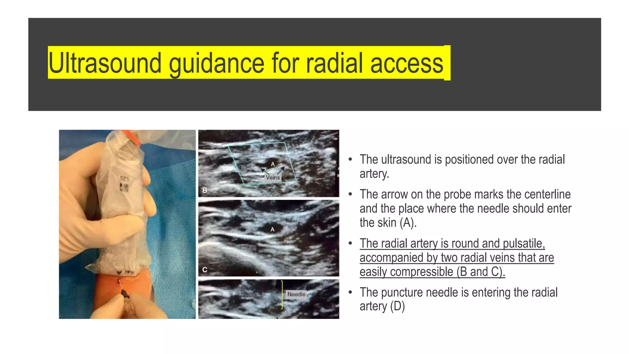 Ultrasound guidance for radial access
• The ultrasound is positioned over the radial
artery.
• The arrow on the probe marks the centerline
and the place where the needle should enter
the skin (A).
• The radial artery is round and pulsatile,
accompanied by two radial veins that are
easily compressible (B and C).
• The puncture needle is entering the radial
artery (D)
 