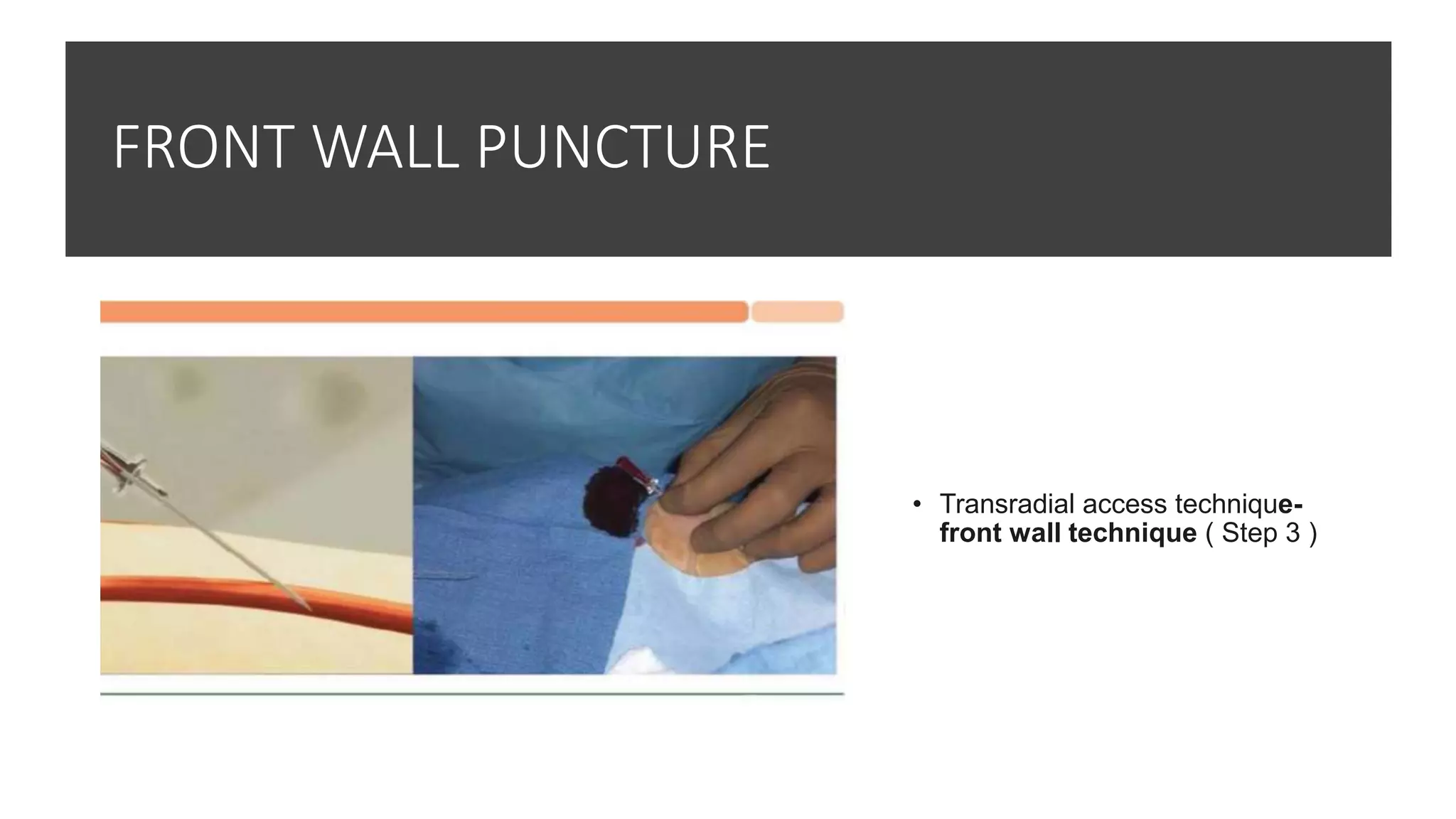FRONT WALL PUNCTURE
• Transradial access technique-
front wall technique ( Step 3 )
 