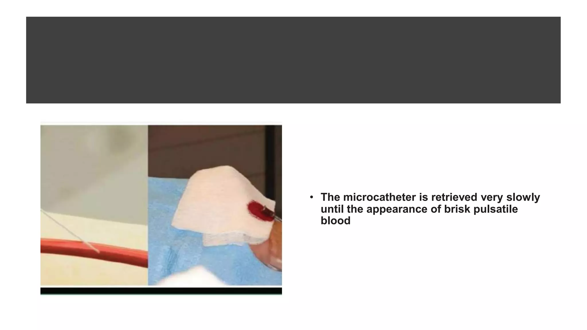 • The microcatheter is retrieved very slowly
until the appearance of brisk pulsatile
blood
 