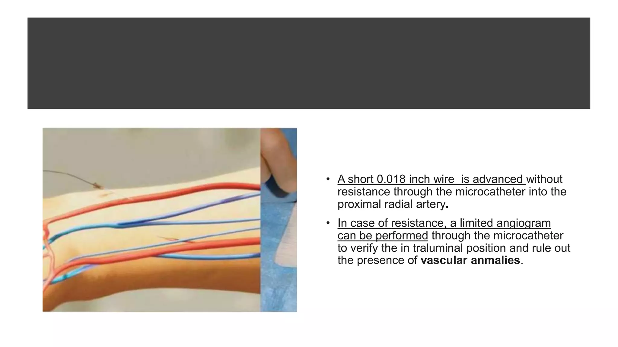 • A short 0.018 inch wire is advanced without
resistance through the microcatheter into the
proximal radial artery.
• In case of resistance, a limited angiogram
can be performed through the microcatheter
to verify the in traluminal position and rule out
the presence of vascular anmalies.
 