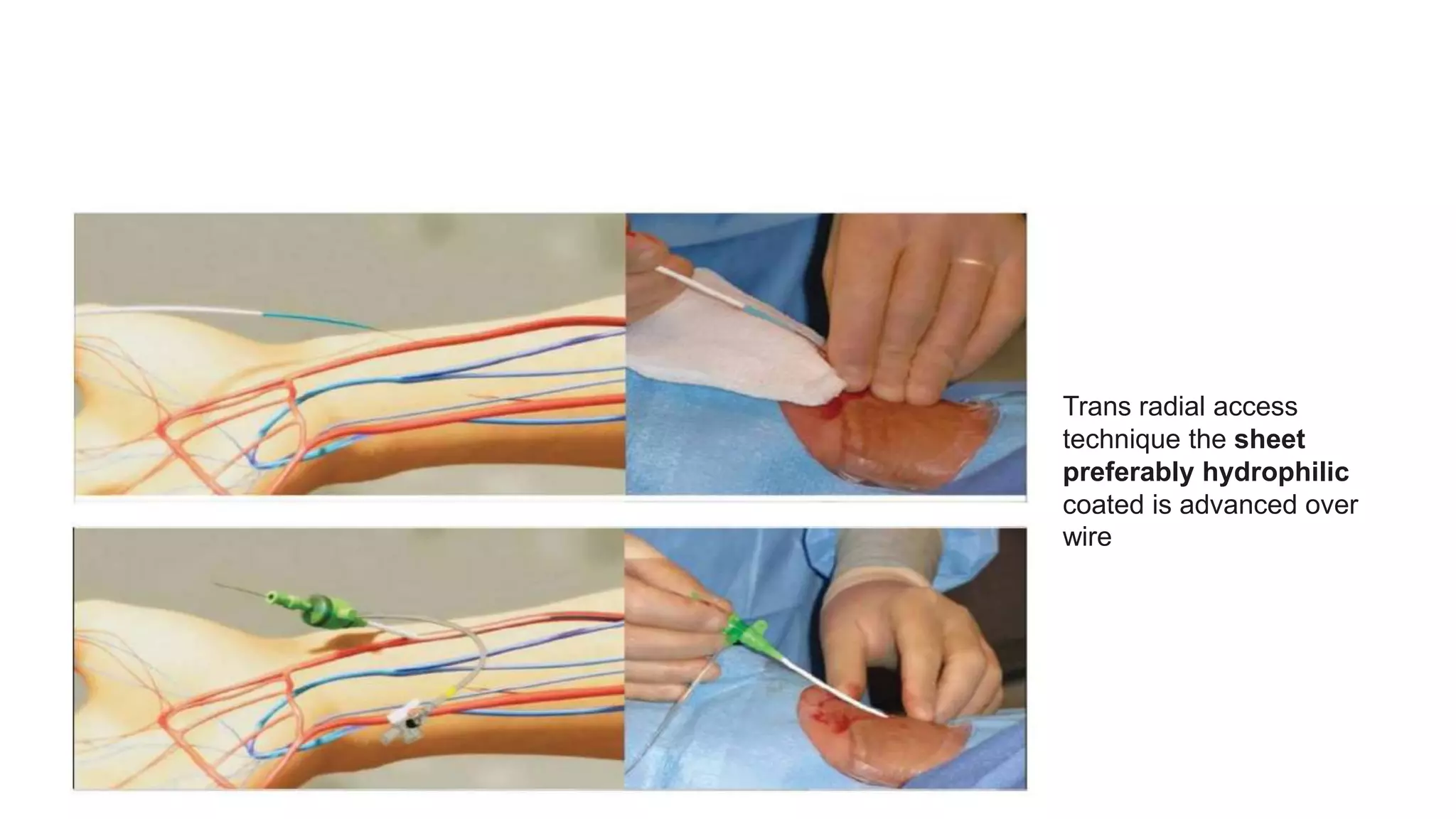 Trans radial access
technique the sheet
preferably hydrophilic
coated is advanced over
wire
 