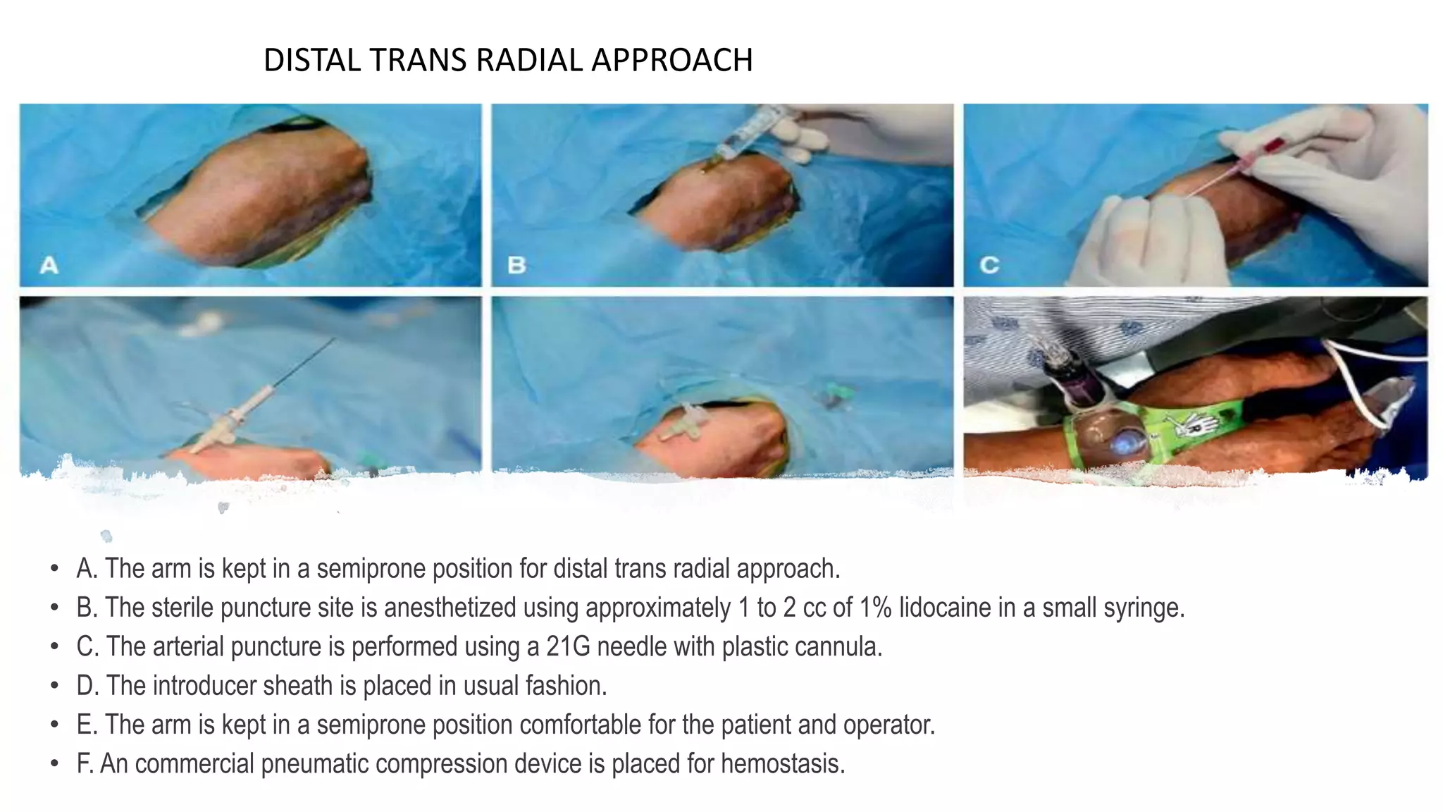 • A. The arm is kept in a semiprone position for distal trans radial approach.
• B. The sterile puncture site is anesthetized using approximately 1 to 2 cc of 1% lidocaine in a small syringe.
• C. The arterial puncture is performed using a 21G needle with plastic cannula.
• D. The introducer sheath is placed in usual fashion.
• E. The arm is kept in a semiprone position comfortable for the patient and operator.
• F. An commercial pneumatic compression device is placed for hemostasis.
DISTAL TRANS RADIAL APPROACH
 