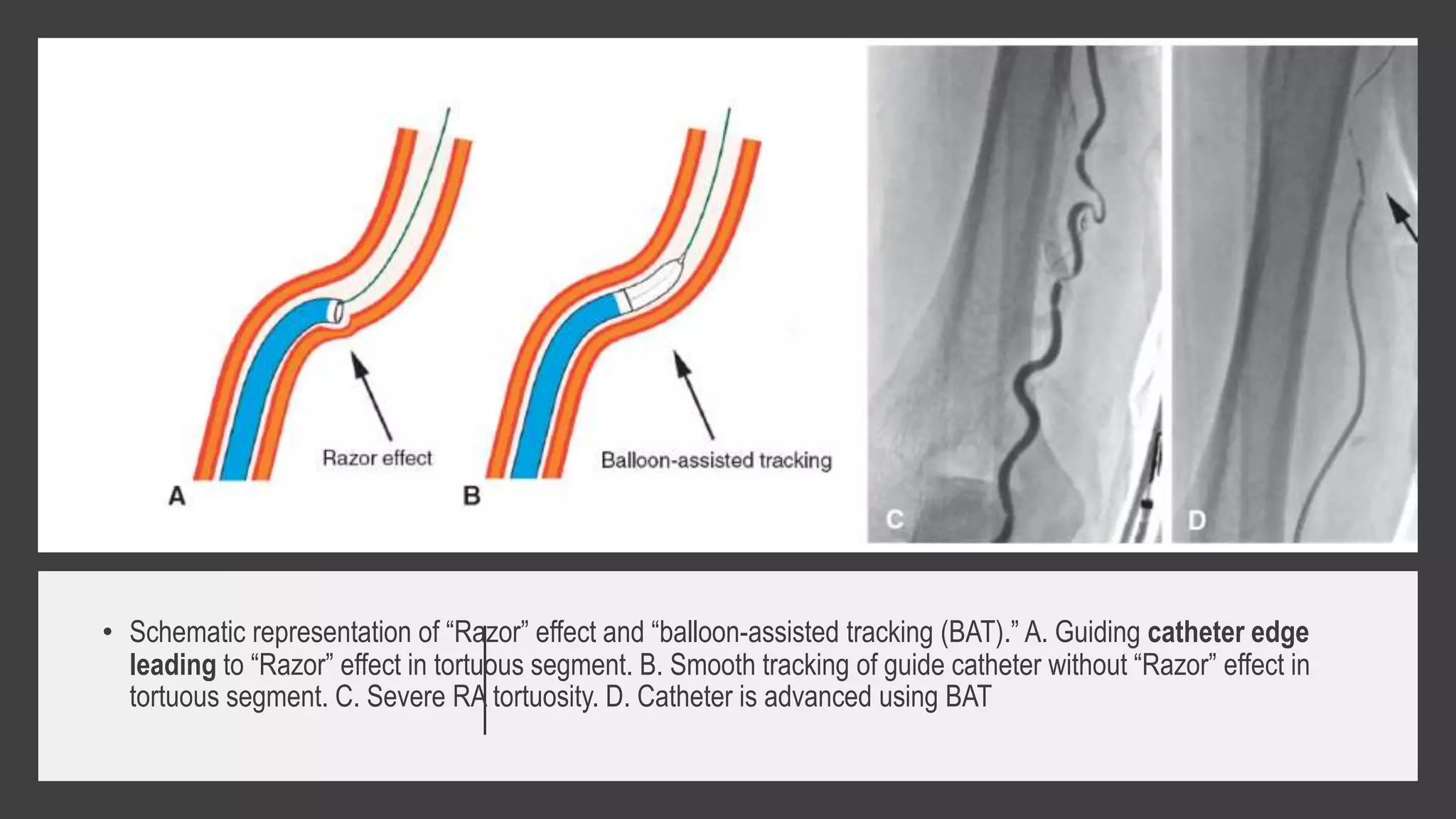 • Schematic representation of “Razor” effect and “balloon-assisted tracking (BAT).” A. Guiding catheter edge
leading to “Razor” effect in tortuous segment. B. Smooth tracking of guide catheter without “Razor” effect in
tortuous segment. C. Severe RA tortuosity. D. Catheter is advanced using BAT
 