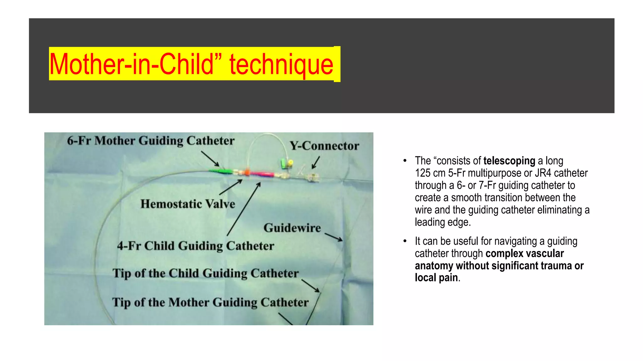 Mother-in-Child” technique
• The “consists of telescoping a long
125 cm 5-Fr multipurpose or JR4 catheter
through a 6- or 7-Fr guiding catheter to
create a smooth transition between the
wire and the guiding catheter eliminating a
leading edge.
• It can be useful for navigating a guiding
catheter through complex vascular
anatomy without significant trauma or
local pain.
 
