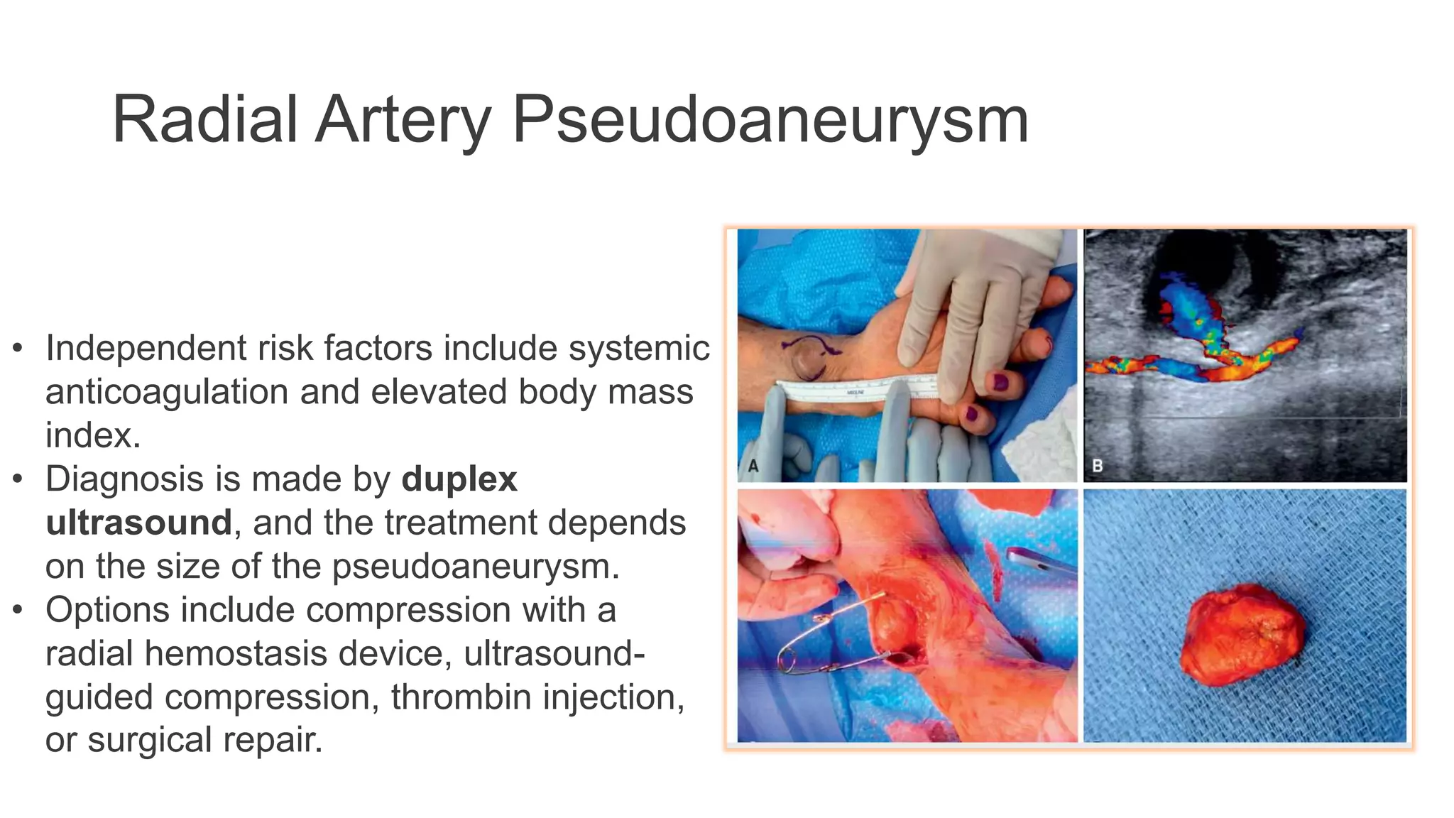 Radial Artery Pseudoaneurysm
• Independent risk factors include systemic
anticoagulation and elevated body mass
index.
• Diagnosis is made by duplex
ultrasound, and the treatment depends
on the size of the pseudoaneurysm.
• Options include compression with a
radial hemostasis device, ultrasound-
guided compression, thrombin injection,
or surgical repair.
 