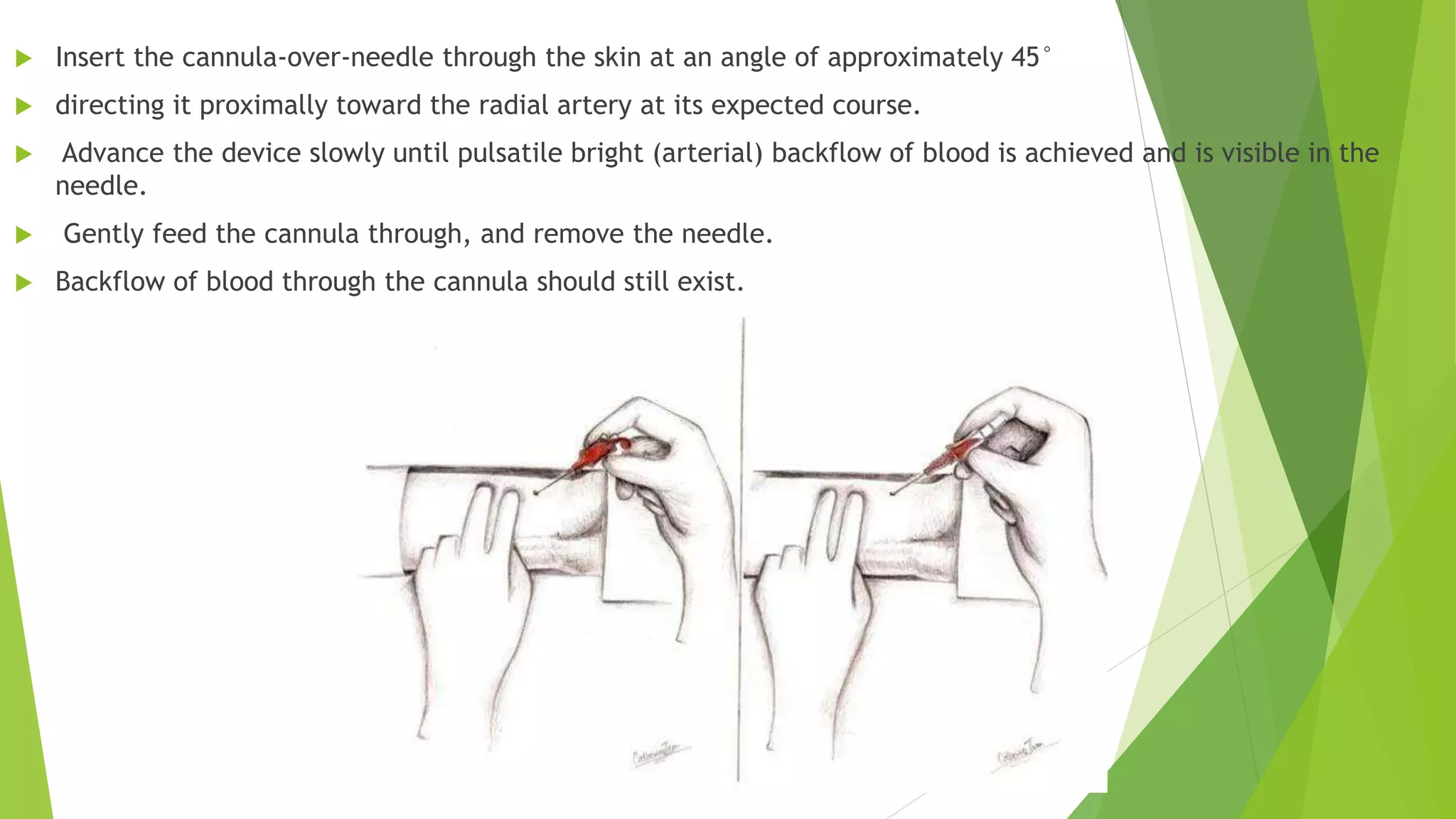 Radial artery access[1] | PPTX
