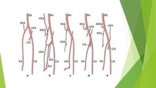 Radial artery access[1] | PPTX