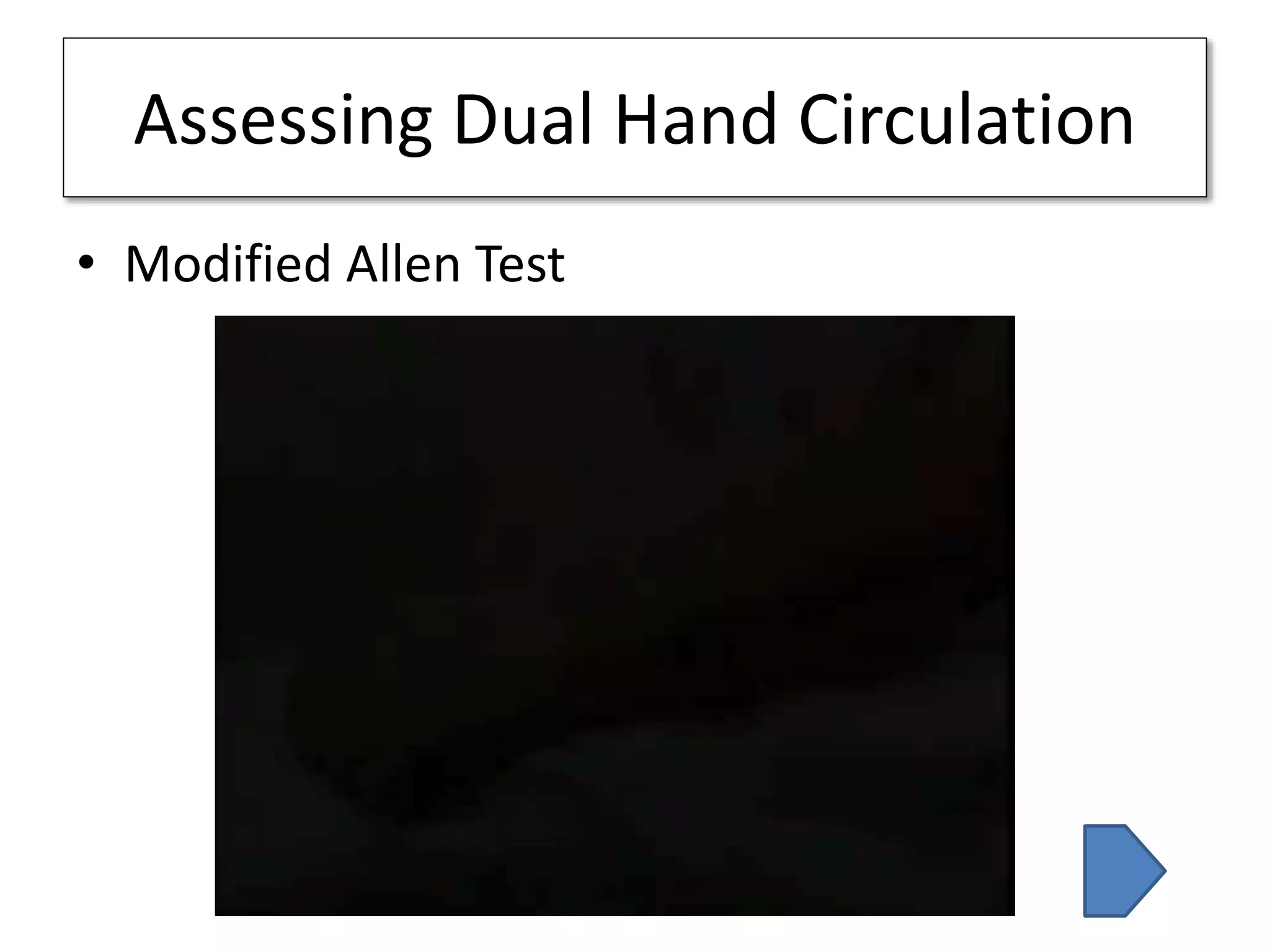 Assessing Dual Hand Circulation
• Modified Allen Test
 