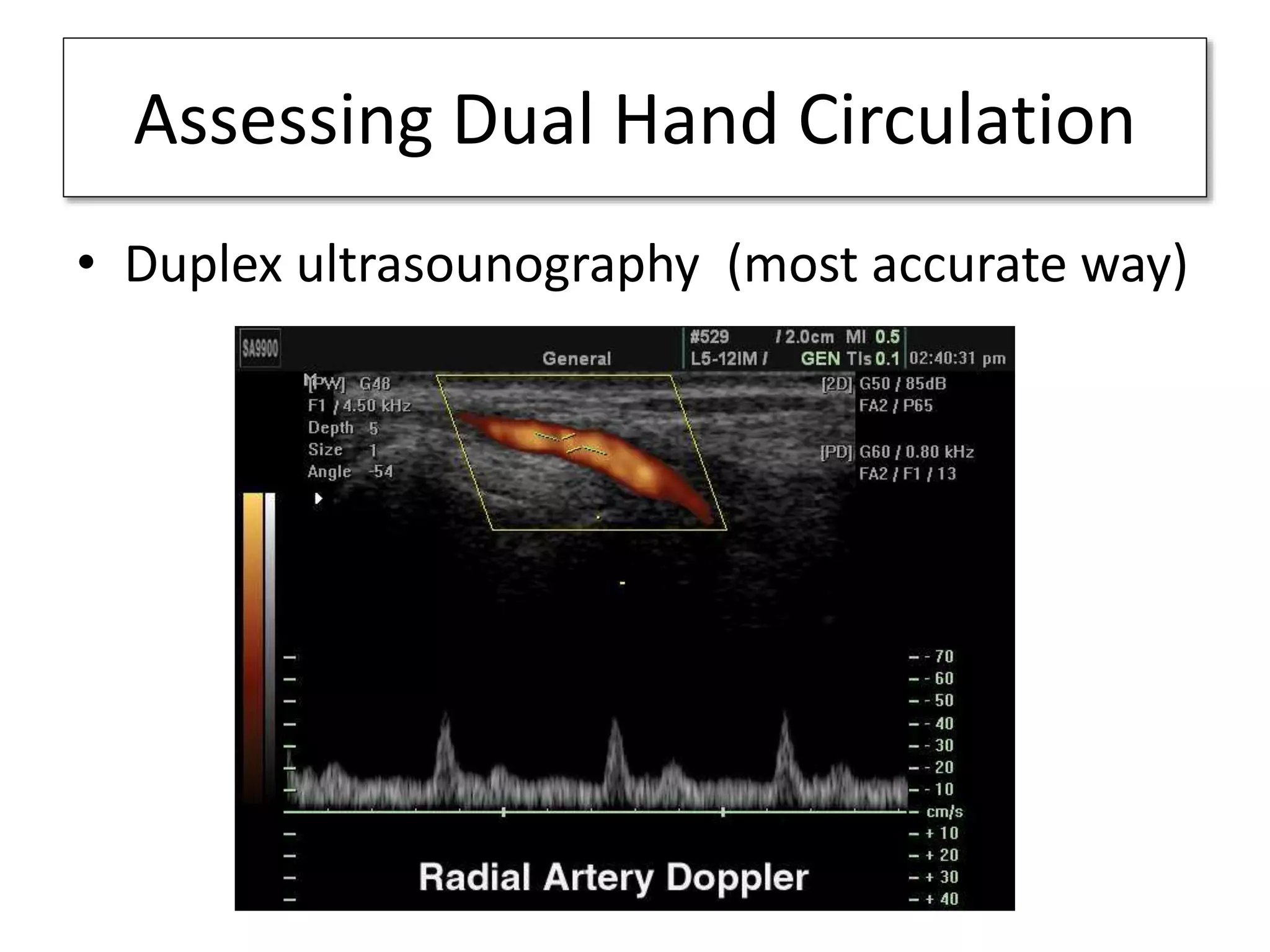 Assessing Dual Hand Circulation
• Duplex ultrasounography (most accurate way)
 