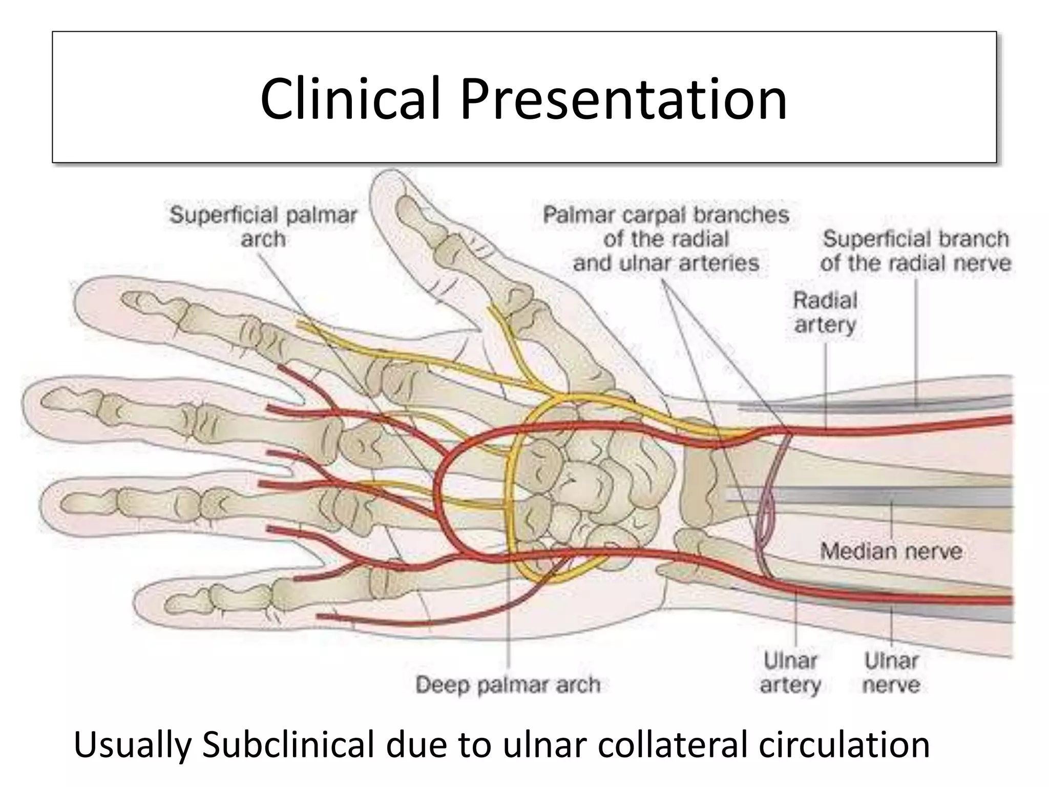 Clinical Presentation
Usually Subclinical due to ulnar collateral circulation
 