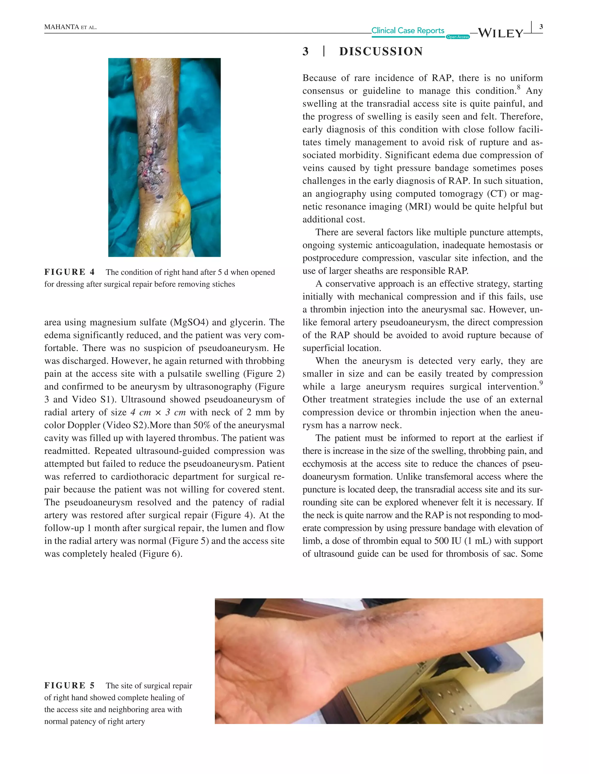 Radial artery pseudoaneurysm | PDF